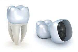 Dental Crowns provided by West Los Angeles Dentist Dr. Cary Charlin DDS