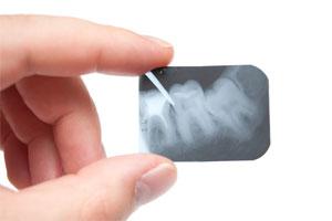 Dental x-rays provided by West Los Angeles Dentist Dr. Cary Charlin DDS