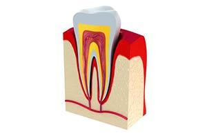Endodontics provided by West Los Angeles dentist Dr. Cary Charlin DDS